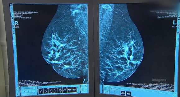 Entenda quais são as formas de prevenção e diagnóstico do câncer de mama